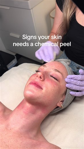 Signs your skin needs a chemical peel! If your skin is looking dull, has stubborn pigmentation, fine lines or breakouts, a peel may be right for you. Let’s find the best option for you 🫶🏻 #glowingskin #chemicalpeel #facialsinaz #antiaging #hyperpigmentation