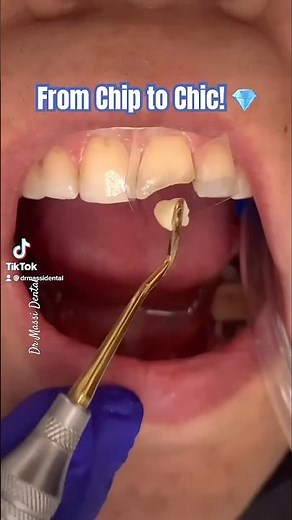 “Chip Gone, Smile On!”Composite Bonding