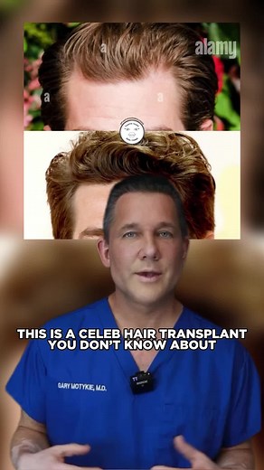 What do you think? Propecia or hair transplant? #AndrewGarfield #AndrewGarfieldEdit #AndrewGarfieldSpiderman #FUEHairTransplant #FUEHairRestoration #FUEHairTransplantation #HairTransplantation #MalePatternBaldness #CelebrityPlasticSurgery #CelebrityBeforeAndAfter #CelebPlasticSurgery #AndrewGarfieldHaircut #HairTransplantSurgery #HairTransplantBeforeAfter #PlasticSurgeonExplains #PlasticSurgeryNews #Propecia #Finasteride #HairRestoration #HairRestorationTreatment
