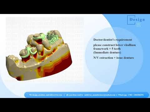 Immediate Denture with Lower Vitallium Framework + Yamahachi Teeth | Extraction & Denture Delivery