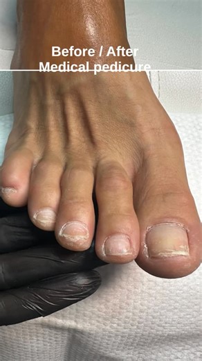 Podolog Top on Instagram: "Before → after cleaning → after medical pedicure Medical pedicure is about health, not just aesthetics. 📍 Dubai Marina"
