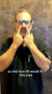 What Is A Mid Facelift?