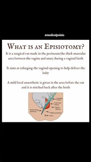In normal delivery role of episiotomy..what is episiotomy and the type of episiotomy #viralvideo