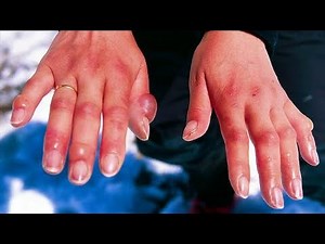 Frostbite vs. frostnip what is the difference and what to look for?