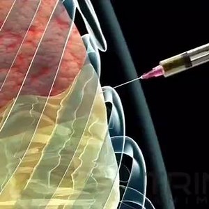 Thoracentesis or pleural tap, is an invasive procedure to remove fluid or air from the pleural space for diagnostic or therapeutic purposes. A cannula, or hollow needle, is carefully introduced into the thorax, generally after administration of local anesthesia. The procedure was first described in 1852. The recommended location varies depending upon the source. Some sources recommend the midaxillary line, in the eighth, ninth, or tenth intercostal space.Whenever possible, the procedure should b