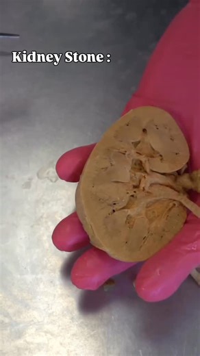 Abhay Mishra | Academic Advisor on Instagram: "Follow🎖️Kidney stones: small crystals, BIG pain 🪨⚡ They don’t appear overnight. Kidney stones form when your urine becomes too concentrated, allowing minerals like calcium, oxalate, or uric acid to crystallize and stick together. Here’s what really happens 👇 • Low water intake → urine gets concentrated • Minerals start forming sharp crystals • Crystals grow into stones inside the kidney • When the stone moves into the ureter, it gets stuck • The