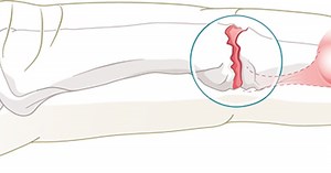 Fingergelenksarthrose | Schulthess Klinik