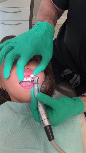 Teeth Bonding Process: Obsessed with the Results!