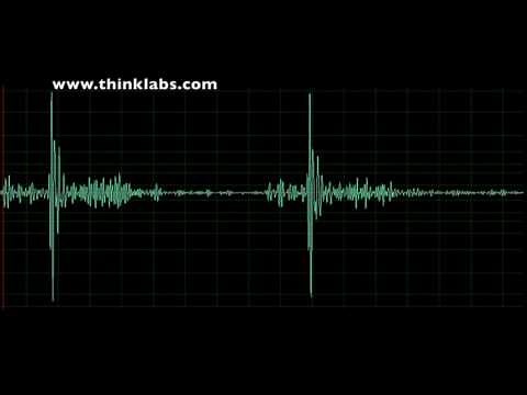Takotsubo Cardiomyopathy