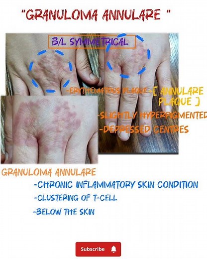 Granuloma Annulare -Dermatology | Skin manifestation of Diabetic mellitus