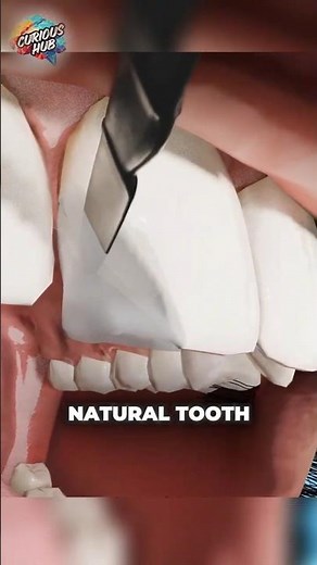 How Dentists Fix Chipped Teeth So Fast 😳🦷
