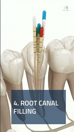ROOT CANAL TREATMENT STEP BY STEP EXPLAINED! 🧐🦷 #shorts