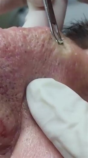 For you OG Popaholics - heres a CLASSIC Mr. Wilson (wait for it) ✌️❤️💥#drpimplepopper #popaholics #oddlysatisfying