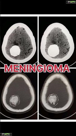 Ct scan #meningioma #radiology