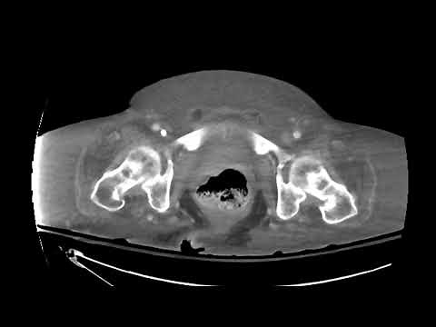 Perforated appendicitis
