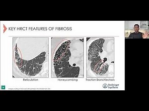 Recognizing Chronic Fibrosing Interstitial Lung Disease and The Impact of COVID-19 on Clinical Care