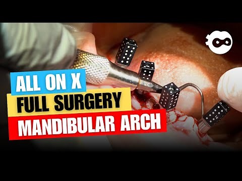 All on X Full Surgery Mandibular Arch