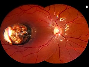 Up Close with a Macular Coloboma