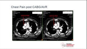 Complications of High-Risk PCI: Case Based Management