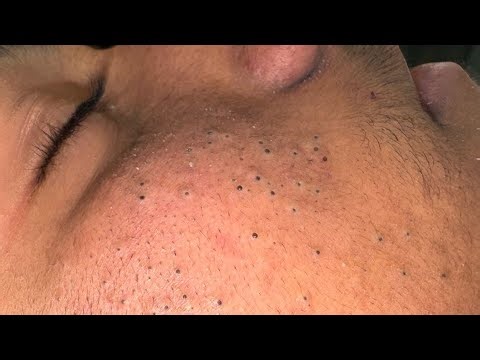 Deep Cleanse for Glowing Skin Blackhead Removal & Acne Treatment Routine