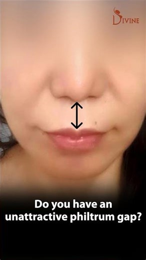 Lip Lift Surgery: Shorten the Philtrum & Enhance Facial Balance #shortfeed