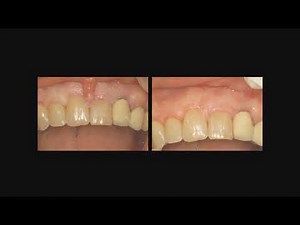 Lecture #17 – Surgical Management of the Maxillary Frenum