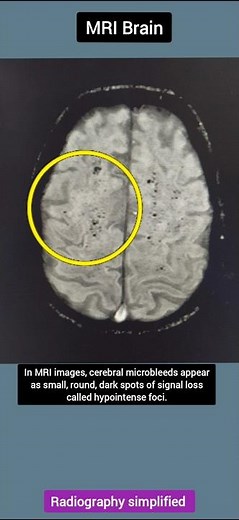Microbleeds on MRI SWI Explained | How to Identify Cerebral Microbleeds | Radiology Shorts”