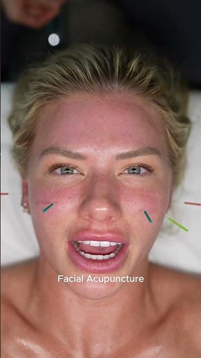Facial Acupuncture Facial in Full Effect