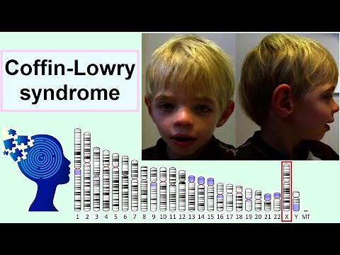 Coffin-Lowry syndrome