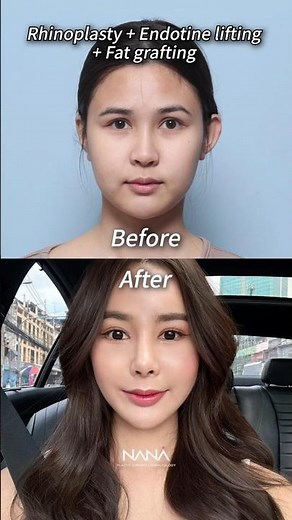 POV: Healing, Growing, Becoming Me ✨ #koreaplasticsurgery