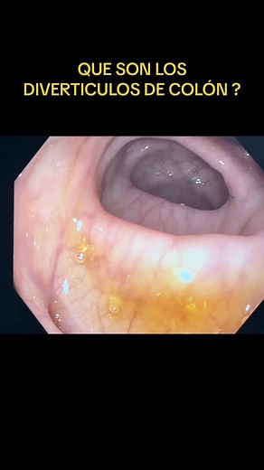 ¿Qué son los divertículos del colon? - Información detallada y prevención