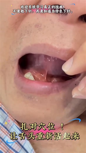 你知道吗？ 口腔下方的 金津、玉液 两个穴位，不仅是中医经典中的“生津要穴”，在临床上更是调理舌体功能的重要位置。 通过精准判断后，采用针刺或适当刺血手法，可以帮助： ✅ 改善舌体僵硬 ✅ 提升发音清晰度与灵活度 ✅ 促进舌下血液循环 ✅ 缓解口干、口苦、口臭问题 ✅ 辅助恢复期的语言功能训练 在部分失语、中风恢复期或舌体活动受限的案例中， 当穴位判断准确，往往一次操作就能观察到变化。 但关键从来不是“扎哪里”， 而是 ✔ 如何判断适应证 ✔ 如何控制深度与出血量 ✔ 如何结合脉象与整体气血状态 ✔ 什么时候该做，什么时候不该做 中医的力量，不在神秘， 而在精准与整体思维。 ⸻ 🎓 想系统学习这类技术？ 如果你希望： • 提升舌下区安全操作能力 • 掌握刺血与针刺的分寸 • 建立脉诊指导下的治疗逻辑 • 在神经系统恢复类案例中更有判断力 欢迎系统学习新平衡针法！ 🔥 新平衡针法国际课程 · 奥克兰｜欧洲｜马来西亚 🇪🇺 欧洲 · 柏林（英文授课｜中文 AI 同步翻译） 🗓 2026年 3月14–16日 🔗 https://acutcmschool.com/26gnba/ —