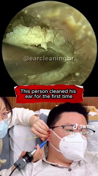Ear Wax Removal Techniques - Satisfying Videos Compilation
