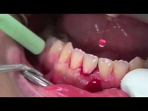 14. Biolase Waterlase iPlus - Perio 1