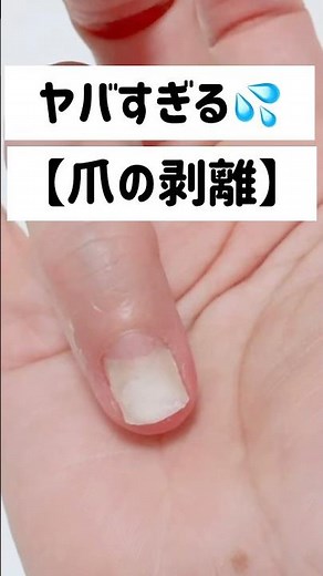 ヤバすぎる爪の剥離#爪の剥離理由#爪の剥離治し方#セルフネイル#ネイルケア #100均ネイル #shein