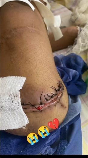 From Tragedy to Triumph She Lost Her Leg but Found Her Strength Again! Amputation artificial limb