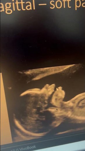 Finding cleft palate on Fetal ultrasound