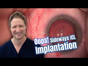 Oops! Sideways ICL Implantation!