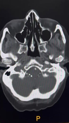 How to Trace Vertebral & Basilar Artery on CT