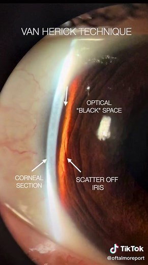 Van Herick Technique for Measuring Corneal Thickness: A Comprehensive Guide