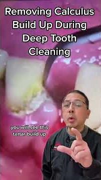 Deep Tooth Cleaning to Remove Calculus with Ultrasonic Scaler| In Office to Hands On Dental Training