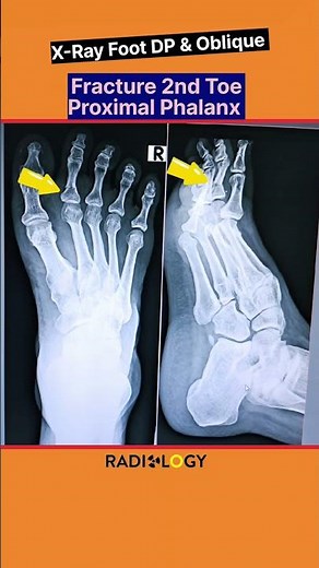 Fracture 2nd Toe Proximal Phalanx⚡X-Ray Foot #shorts #xray