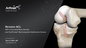 Revision ACL With Cannulated Bone Dowels and FastThread™ BioComposite Interference Screws