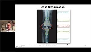 Metaphyseal Bone Defects Treatment - Reconstruction vs Resection