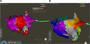 Pulsed field ablation of the cavotricuspid isthmus using a multispline-electrode pulsed field ablation catheter