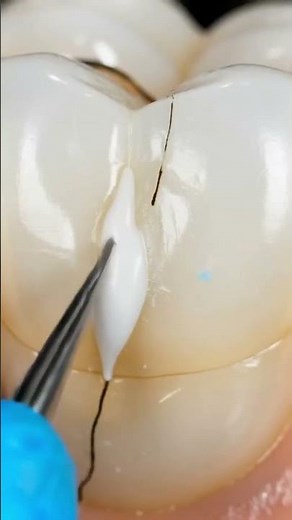 Dantle care. #dentist #satisfying #experiements #piercing