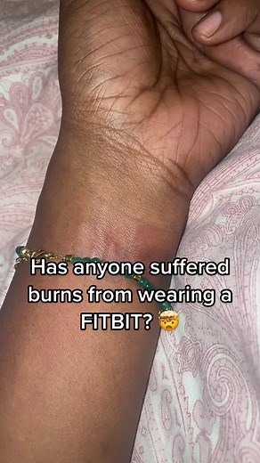 Dealing with Fitbit Strap Irritations: What You Need to Know