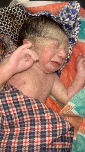 Newborn Delivery Case: Baby Passed Meconium Inside Womb and Successfully Stabilized After Birth #NewbornCase #MeconiumDelivery #BabyCare #HealthyBaby #NeonatalCare #DeliveryCase #MedicalAwareness #ProfessionalCare #NICU #NewLife | Little Angel Care