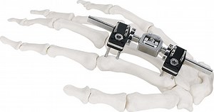 [Hot Item] External Fixator Hand Bone Pin Stent Radius External Fixator Mini Fixator Joint Motion Type