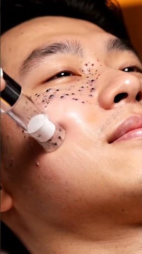 “Deepest Full Face Blackhead Removal Ever Recorded”